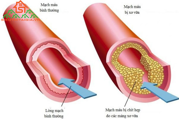 Máu nhiễm mỡ