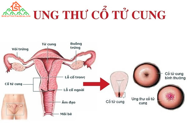 Chích ngừa ung thư cổ tử cung