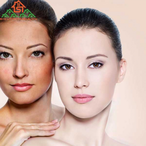 Cách Chăm Sóc Da Mặt Bị Sạm Đen Đơn Giản Cho Các Cô Gái