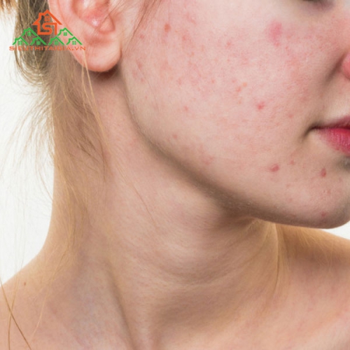 Cách Chăm Sóc Da Dầu Mụn Tại Nhà Và Những Lưu Ý Cơ Bản