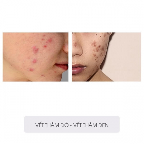 Cách Chăm Sóc Da Mụn Và Thâm Giúp Bạn Tự Tin Rạng Ngời