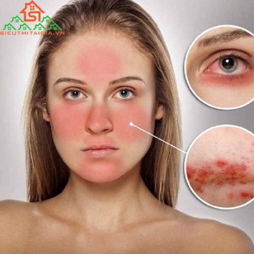 Những Cách Trị Mụn Cho Da Nhạy Cảm Đơn Giản Và Dễ Thực Hiện