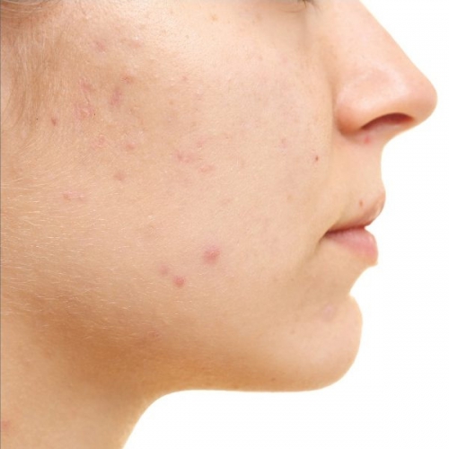 Các Bước SKincare Cho Da Mụn Ẩn Đúng Cách Không Nên Bỏ Qua