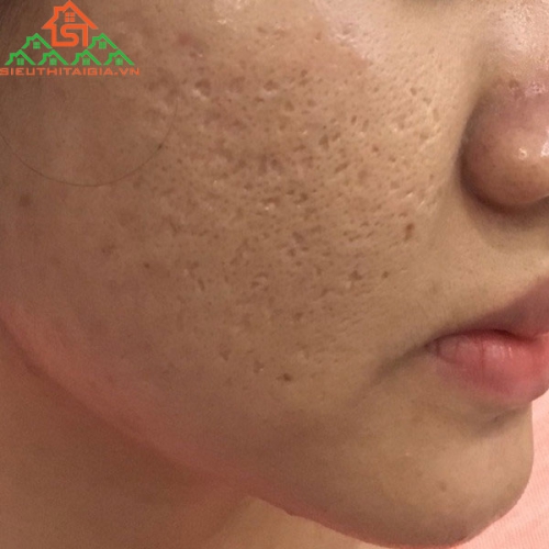 Làm Thế Nào Để Chăm Sóc Da Bị Sẹo Rỗ Hiệu Quả Ngay Tại Nhà?