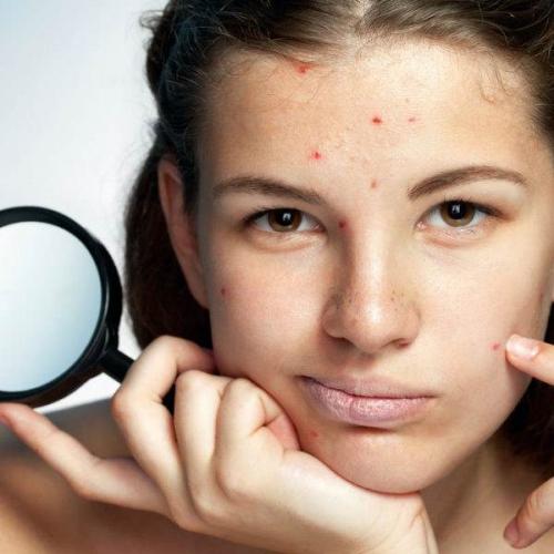 Cách chăm sóc da bị nhiễm corticoid an toàn và hiệu quả cho da 