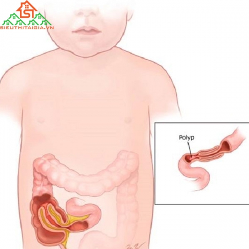 Những Điều Cần Biết Về Lồng Ruột Ở Trẻ Em