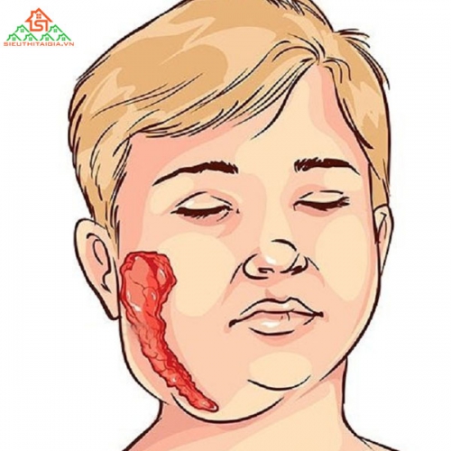 Dấu Hiệu Quai Bị Bạn Cần Biết