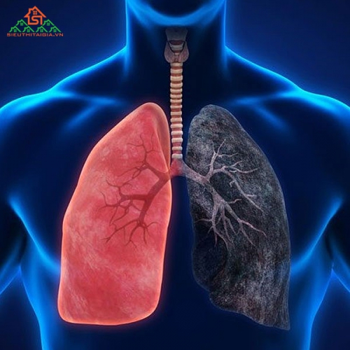 Bệnh Phổi Tắc Nghẽn Mãn Tính COPD Là Gì?