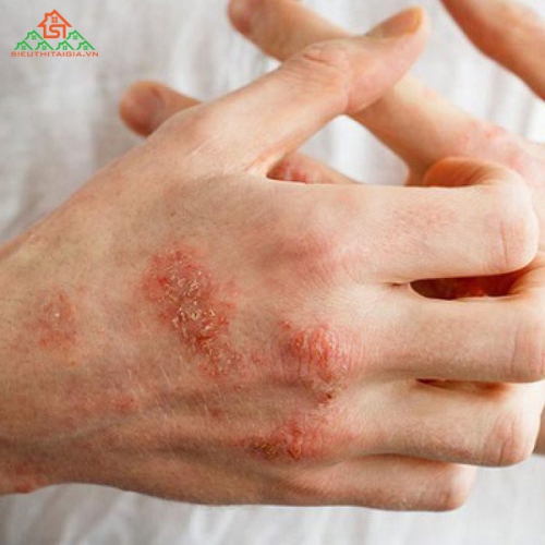 Dấu Hiệu Và Cách Điều Trị Bệnh Chàm Thế Nào?