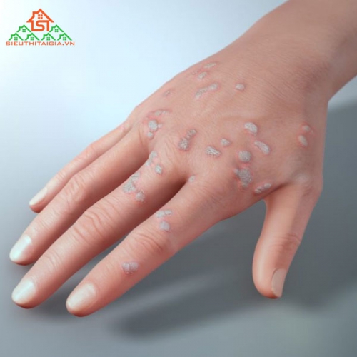 Những Phương Pháp Điều Trị Mụn Cóc Hiệu Quả Tại Nhà