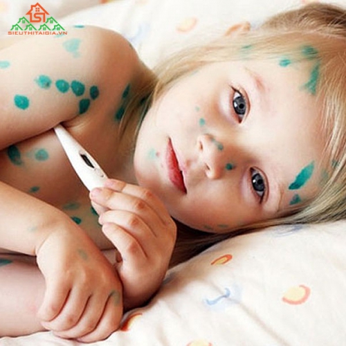Thủy Đậu: Nguyên Nhân Gây Bệnh Và Cách Điều Trị