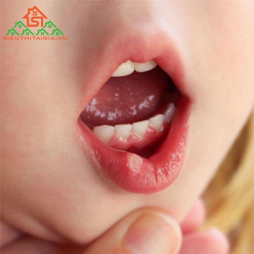 Những Cách Chữa Nhiệt Miệng Đơn Giản Hiệu Quả Tại Nhà