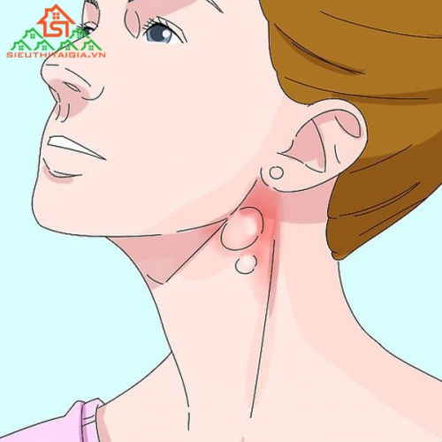 Hạch Bạch Huyết Và Cảnh Báo Các Bệnh Liên Quan