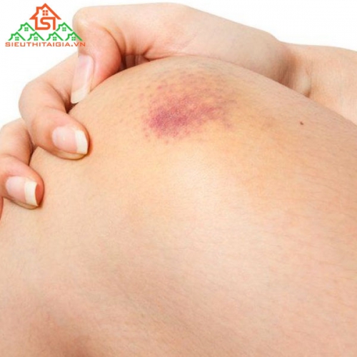 Xuất Huyết Dưới Da Là Bệnh Gì?