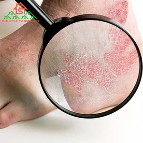 Không Còn Ngứa Ngáy Với Top Thuốc Trị Hắc Lào