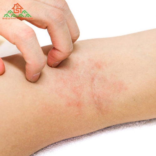 Tìm Hiểu Về Bệnh Viêm Da Cơ Địa