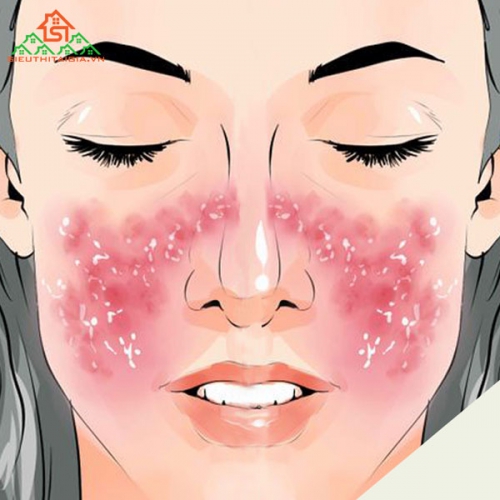 Viêm Da Tiết Bã: Nguyên Nhân, Dấu Hiệu Và Cách Điều Trị