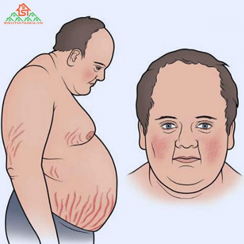 Hội Chứng Cushing Là Gì? Nguyên Nhân Và Điều Trị Thế Nào?
