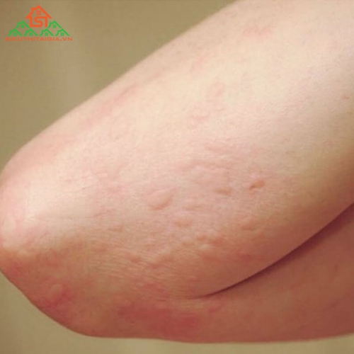 Viêm Da Dị Ứng Phải Điều Trị Thế Nào?