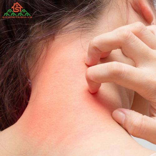 Những Điều Cần Biết Về Viêm Da Tiếp Xúc
