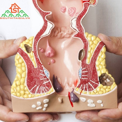 Kiến Thức Chữa Bệnh Trĩ An Toàn, Hiệu Quả