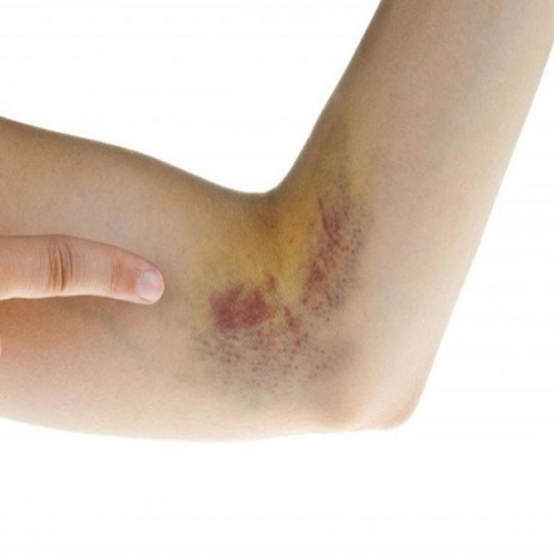Bị sưng, bầm tím nên chườm nóng hay lạnh?