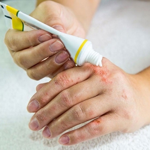 Bị kiến ba khoang cắn bôi gì cho mau lành?