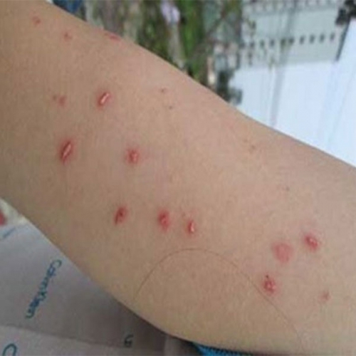 Zona thần kinh và kiến ba khoang cắn khác nhau như thế nào?