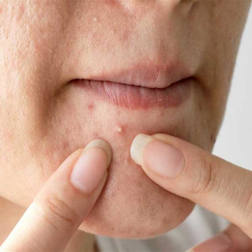 Mụn mủ có nên nặn không? Lưu ý gì khi chăm sóc da bị mụn mủ?