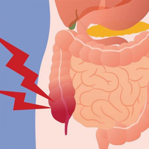 Áp xe ruột thừa là gì? Phương pháp khắc phục bệnh thế nào?