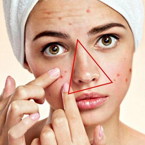 Bạn có biết vì sao không nên nặn mụn trứng cá?