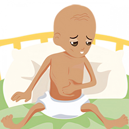 Suy dinh dưỡng thể marasmus là gì? Dấu hiệu và cách điều trị