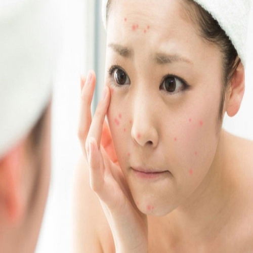Hướng dẫn cách massage mặt trị mụn hiệu quả trong 1 tuần